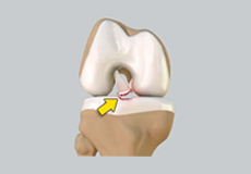 Tibial Eminence Fractures