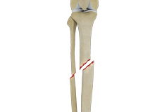 Tibial Shaft Fracture