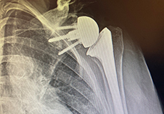 Total Shoulder Replacement