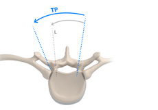 Transpedicular Approach Surgery