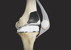 Tricompartmental Knee Replacement