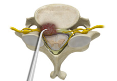 Tumor Decompression