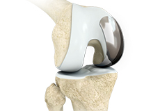 Outpatient Unicondylar Knee Replacement
